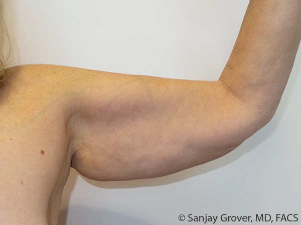 Arm Lift Before and After 08 | Sanjay Grover MD FACS