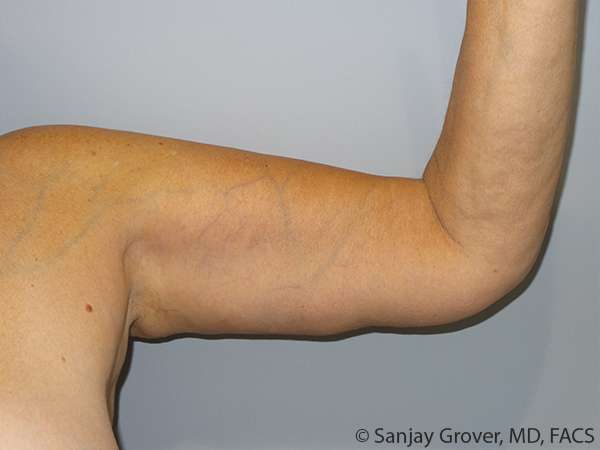 Arm Lift Before and After 08 | Grover Aesthetics
