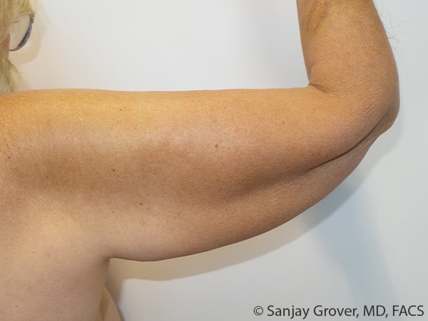 Arm Lift Before and After 08 | Grover Aesthetics