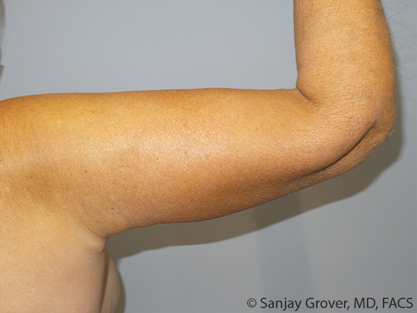 Arm Lift Before and After 08 | Sanjay Grover MD FACS