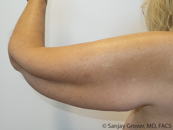 Arm Lift Before and After 08 | Sanjay Grover MD FACS