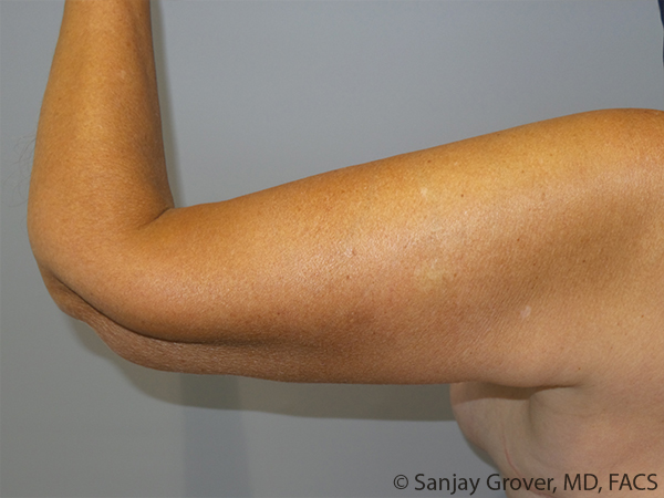 Arm Lift Before and After 08 | Sanjay Grover MD FACS