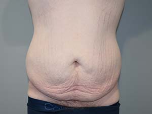 Belt Lipectomy Before and After | Grover Aesthetics