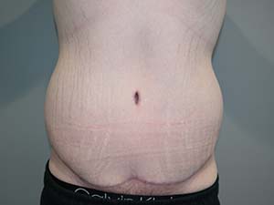Belt Lipectomy Before and After | Grover Aesthetics