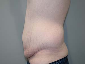 Belt Lipectomy Before and After 01 | Grover Aesthetics