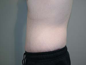 Belt Lipectomy Before and After 01 | Grover Aesthetics