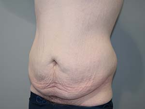 Belt Lipectomy Before and After 01 | Grover Aesthetics