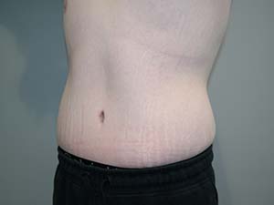 Belt Lipectomy Before and After 01 | Grover Aesthetics
