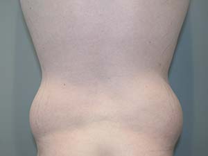 Belt Lipectomy Before and After 01 | Grover Aesthetics
