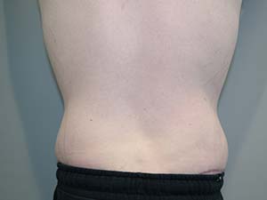 Belt Lipectomy Before and After 01 | Grover Aesthetics