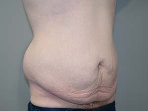 Belt Lipectomy Before and After 01 | Grover Aesthetics
