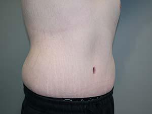 Belt Lipectomy Before and After 01 | Grover Aesthetics