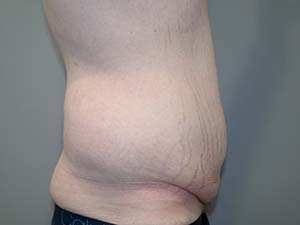 Belt Lipectomy Before and After 01 | Grover Aesthetics