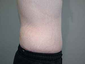 Belt Lipectomy Before and After 01 | Grover Aesthetics