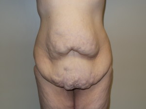 Belt Lipectomy Before and After | Grover Aesthetics