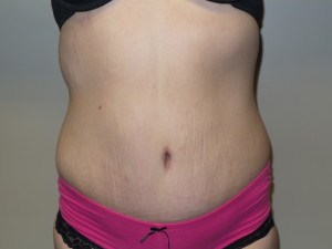 Belt Lipectomy Before and After | Grover Aesthetics