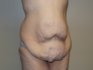 Belt Lipectomy Before and After 02 | Grover Aesthetics