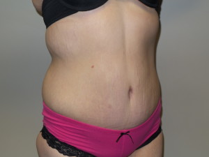 Belt Lipectomy Before and After 02 | Grover Aesthetics