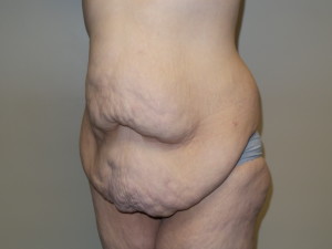 Belt Lipectomy Before and After 02 | Grover Aesthetics