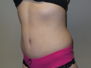 Belt Lipectomy Before and After 02 | Grover Aesthetics