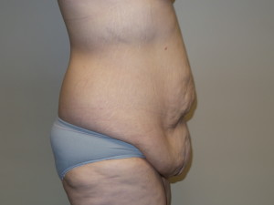 Belt Lipectomy Before and After 02 | Grover Aesthetics