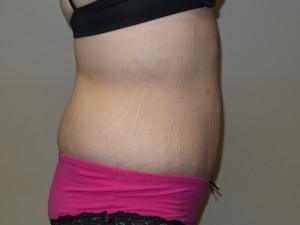 Belt Lipectomy Before and After 02 | Grover Aesthetics