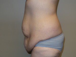 Belt Lipectomy Before and After 02 | Grover Aesthetics