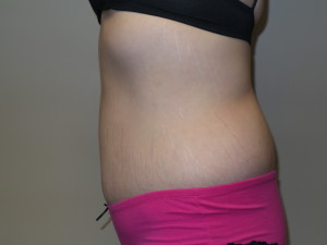 Belt Lipectomy Before and After 02 | Grover Aesthetics