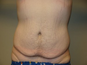Belt Lipectomy Before and After | Grover Aesthetics