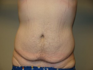 Belt Lipectomy Before and After 03