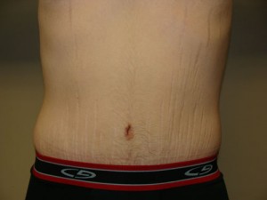 Belt Lipectomy Before and After | Grover Aesthetics