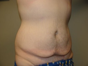 Belt Lipectomy Before and After 03 | Grover Aesthetics