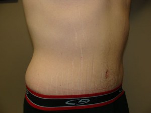 Belt Lipectomy Before and After 03 | Grover Aesthetics