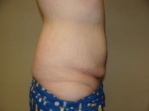 Belt Lipectomy Before and After 03 | Grover Aesthetics