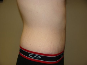 Belt Lipectomy Before and After 03 | Grover Aesthetics