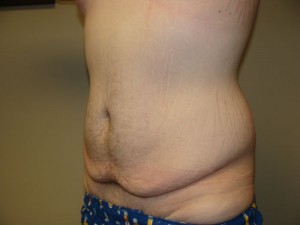 Belt Lipectomy Before and After 03 | Grover Aesthetics