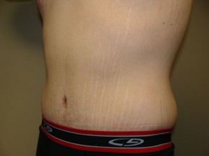 Belt Lipectomy Before and After 03 | Grover Aesthetics