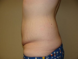 Belt Lipectomy Before and After 03 | Grover Aesthetics