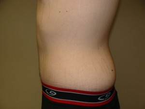 Belt Lipectomy Before and After 03 | Grover Aesthetics