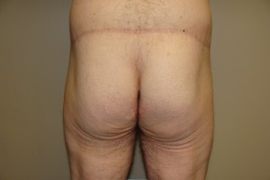 Belt Lipectomy Before and After 04 | Grover Aesthetics