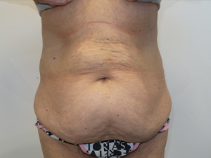 Belt Lipectomy Before and After | Grover Aesthetics