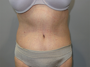 Belt Lipectomy Before and After | Grover Aesthetics