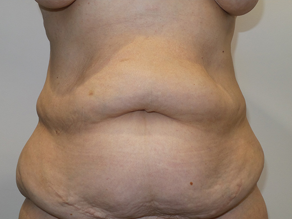 Belt Lipectomy Before and After | Grover Aesthetics