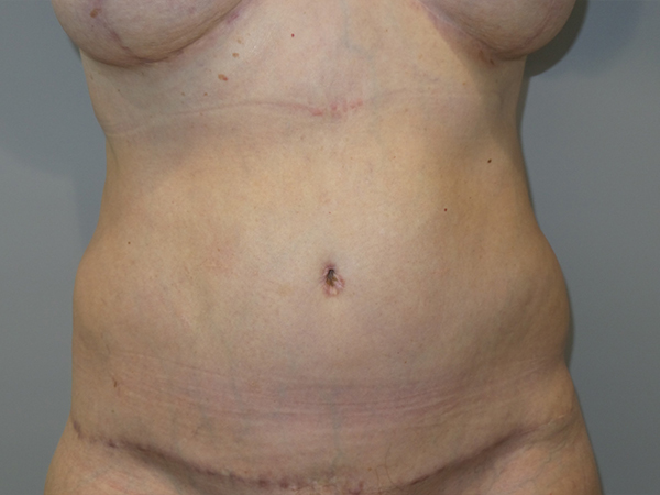 Belt Lipectomy Before and After | Grover Aesthetics