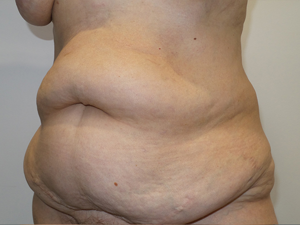 Belt Lipectomy Before and After 06 | Grover Aesthetics