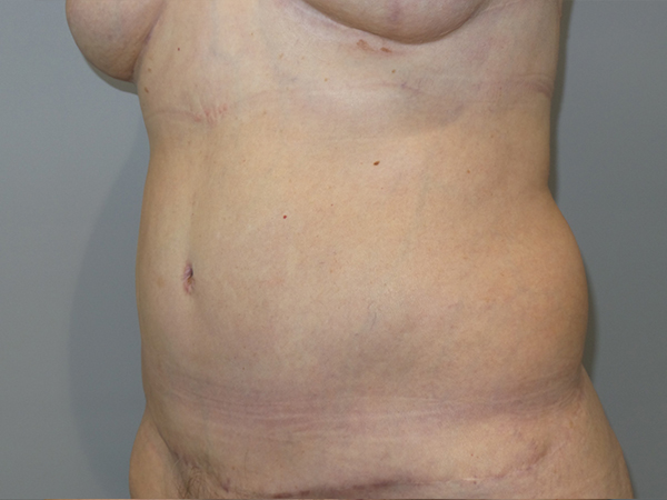 Belt Lipectomy Before and After 06 | Grover Aesthetics