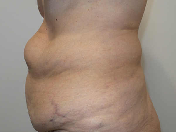 Belt Lipectomy Before and After 06 | Grover Aesthetics