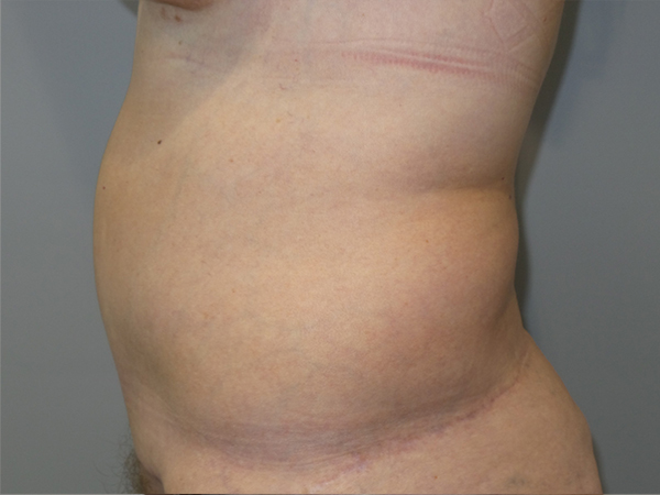 Belt Lipectomy Before and After 06 | Grover Aesthetics