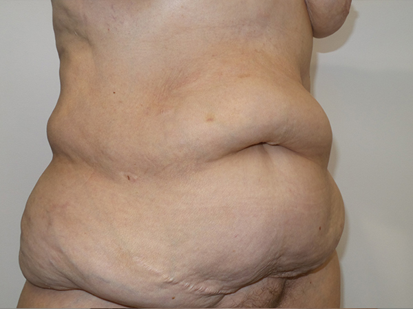 Belt Lipectomy Before and After 06 | Grover Aesthetics