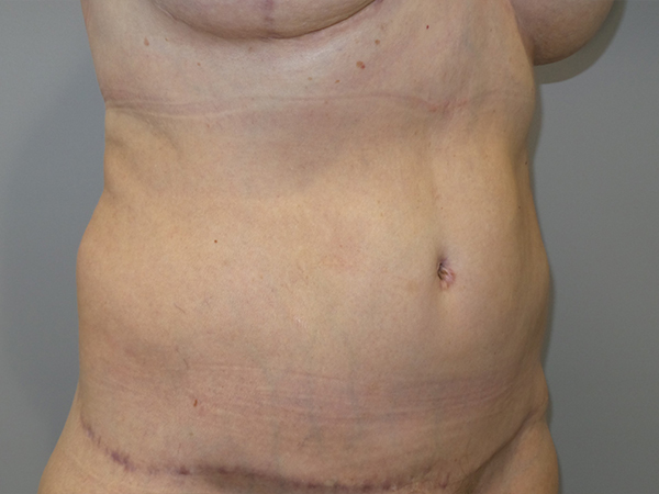 Belt Lipectomy Before and After 06 | Grover Aesthetics